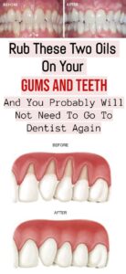 Rub These Two Oils On Your Gums And Teeth And You Proobably Will not Need to go to Dentist Again