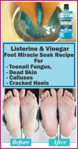 Listerine & Vinegar Foot Miracle Soak Recipe for Toenail Fungus, Dead Skin, Calluses and Cracked Heels