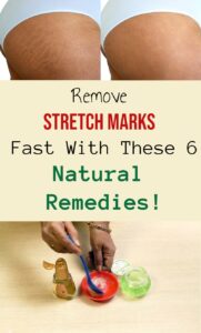 Remove Stretch Marks Fast With These 6 Natural Remedies!