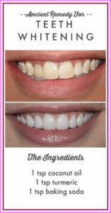 Ancient Remedy for Modern Day Teeth Whitening